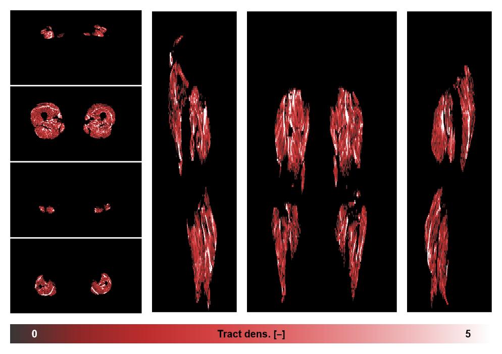 Muscle fiber tract density map based on whole leg DTI based fiber tractography.
