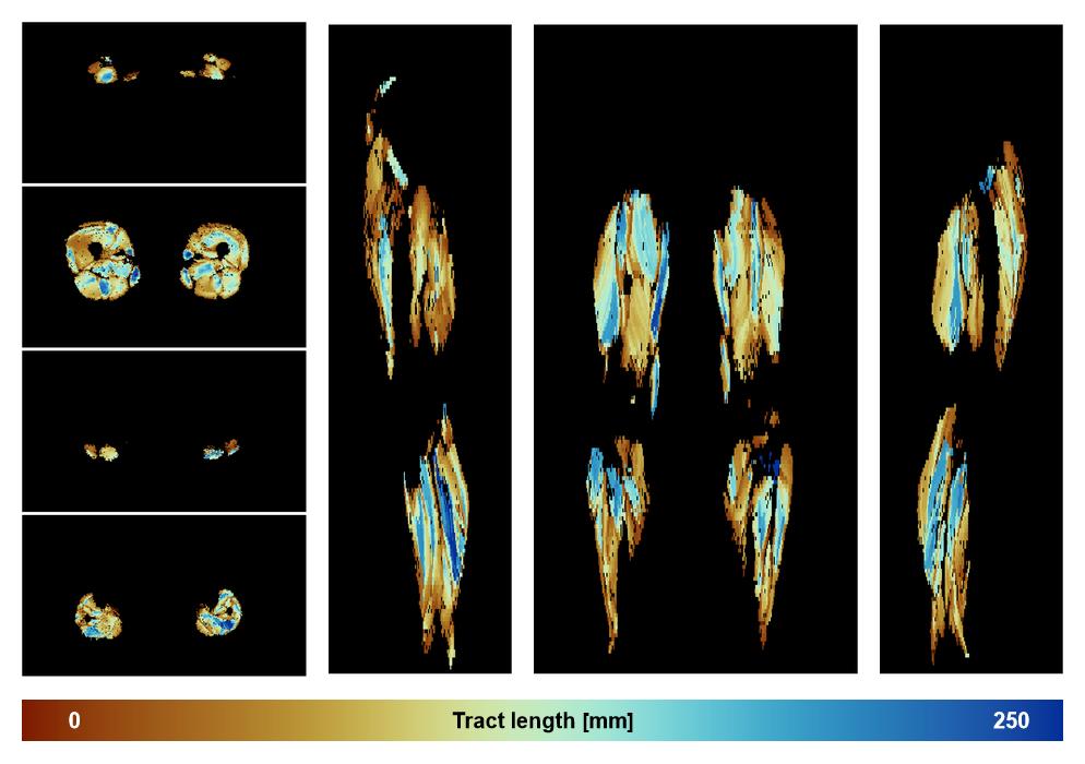 Muscle fiber tract length map based on whole leg DTI based fiber tractography.