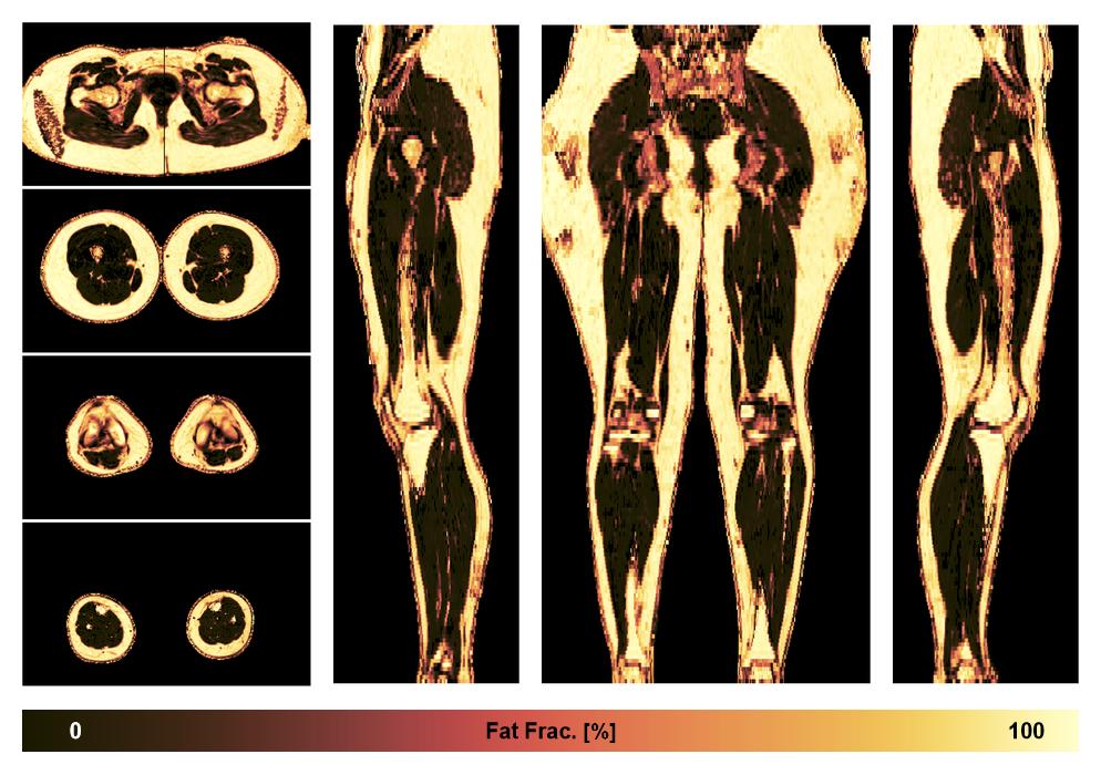 The fat fraction of the lower extremity obtained from the dixon reconstruction for muscle water fat quantification.