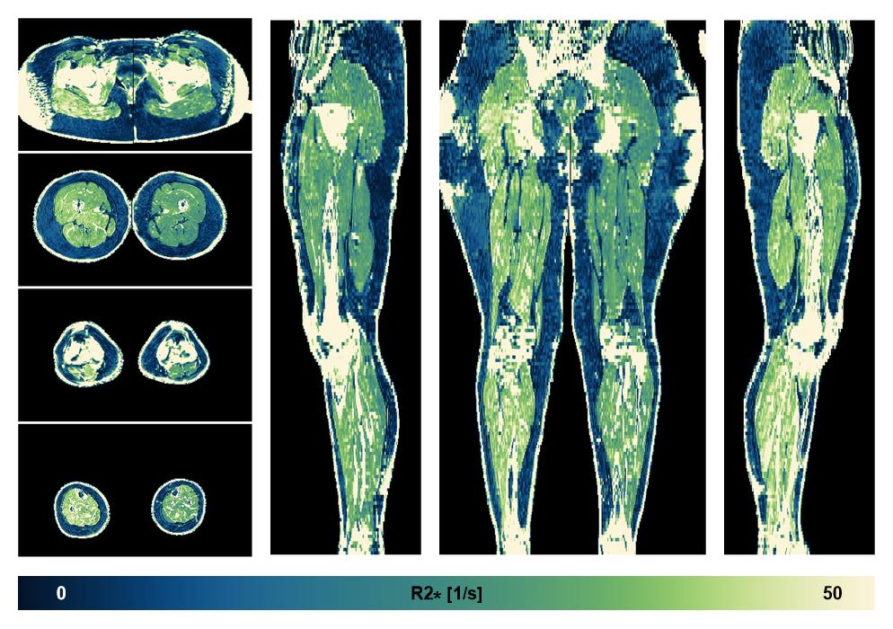 The R2 star relaxation time of the lower extremity obtained from the dixon reconstruction for muscle water fat quantification.