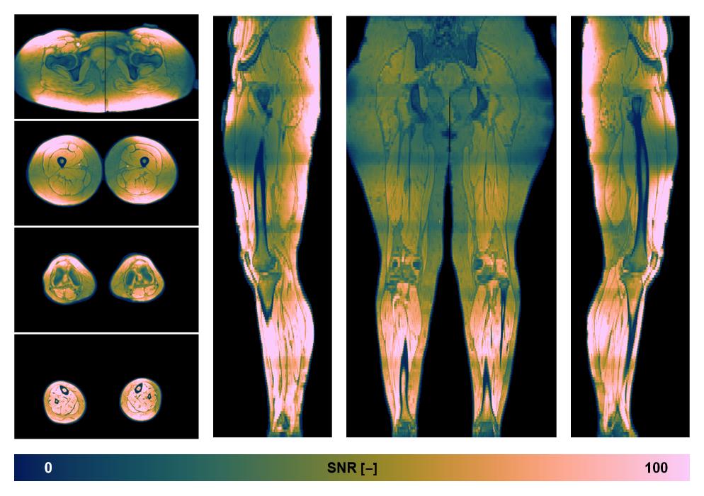 The SNR distribution of the dixon data.