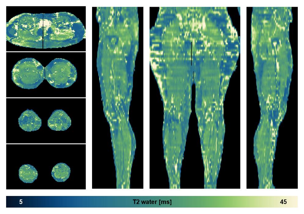 The water only T2 relaxation time of the lower extremity obtained from multi echo spin echo t2 mapping with EPG based reconstruction.