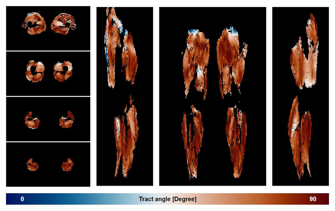 Muscle fiber tract angle map based on whole leg DTI based fiber tractography.