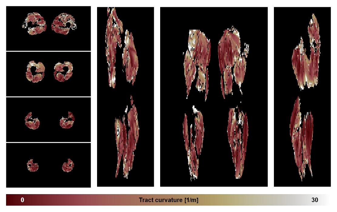 Muscle fiber tract curvature map based on whole leg DTI based fiber tractography.