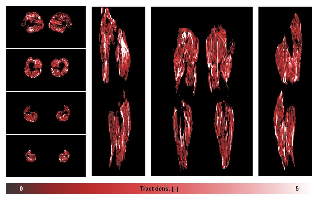 Muscle fiber tract density map based on whole leg DTI based fiber tractography.