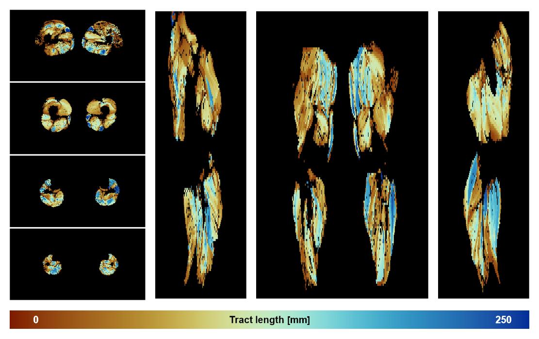 Muscle fiber tract length map based on whole leg DTI based fiber tractography.