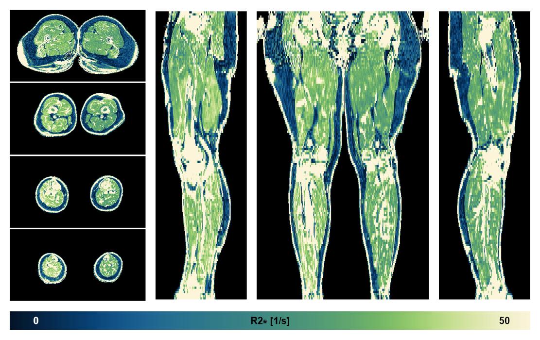 The R2 star relaxation time of the lower extremity obtained from the dixon reconstruction for muscle water fat quantification.
