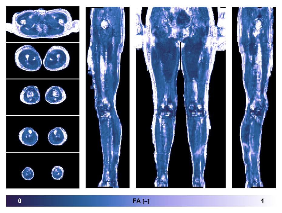 IVIM corrected whole leg muscle fractional anisotropy obtained from diffusion tensor imaging.