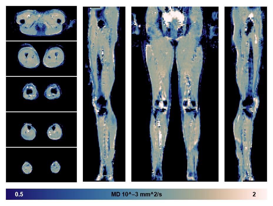 IVIM corrected whole leg muscle mean diffusivity obtained from diffusion tensor imaging.