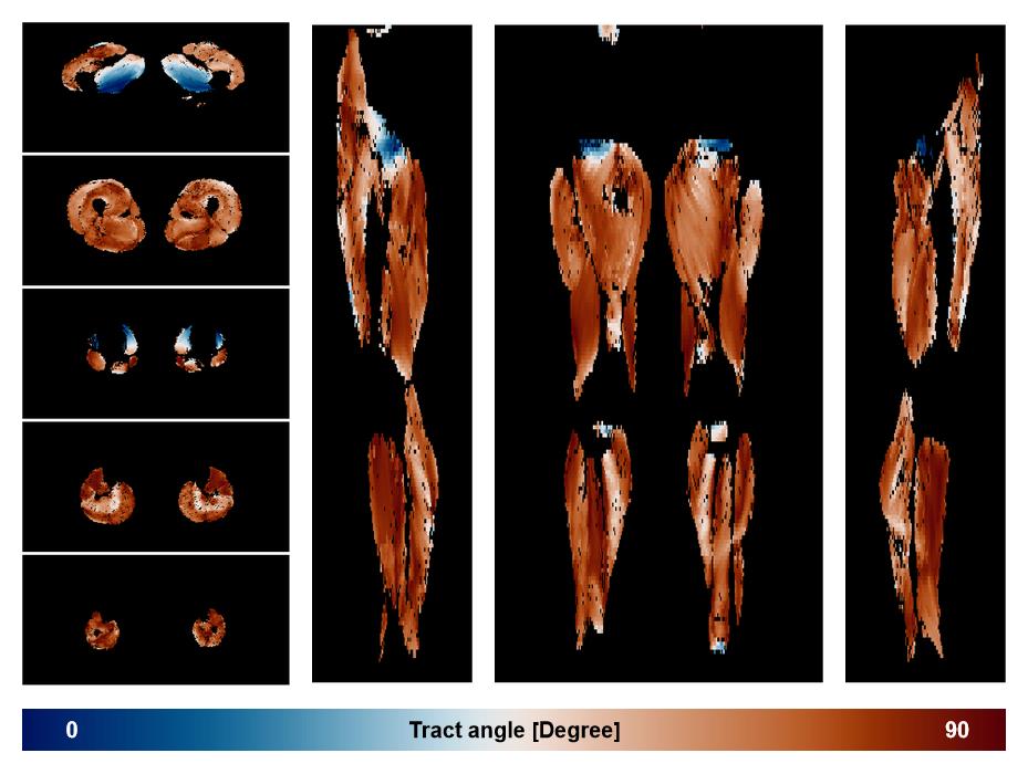Muscle fiber tract angle map based on whole leg DTI based fiber tractography.