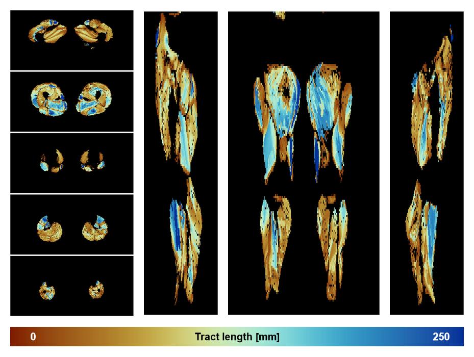 Muscle fiber tract length map based on whole leg DTI based fiber tractography.