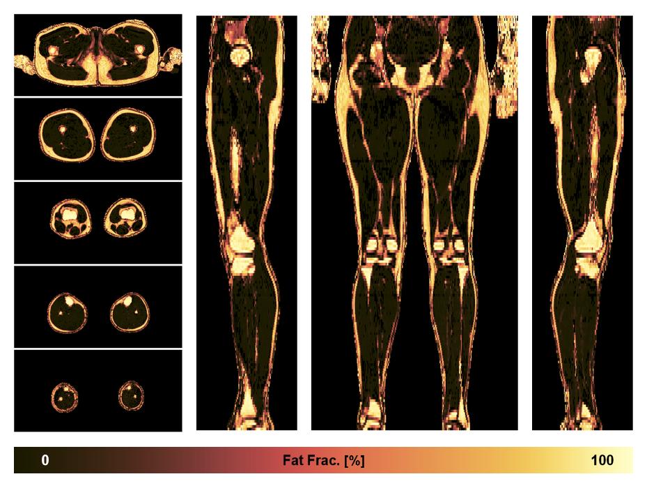 The fat fraction of the lower extremity obtained from the dixon reconstruction for muscle water fat quantification.