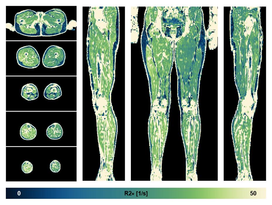 The R2 star relaxation time of the lower extremity obtained from the dixon reconstruction for muscle water fat quantification.