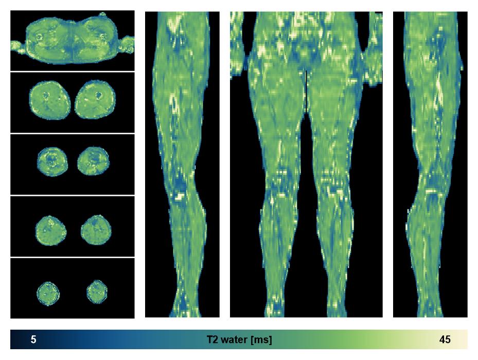 The water only T2 relaxation time of the lower extremity obtained from multi echo spin echo t2 mapping with EPG based reconstruction.