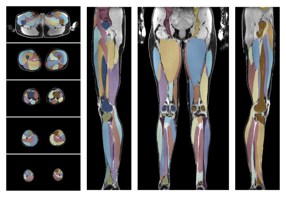Overlay of automated muscle segmentation labels on dixon water image.