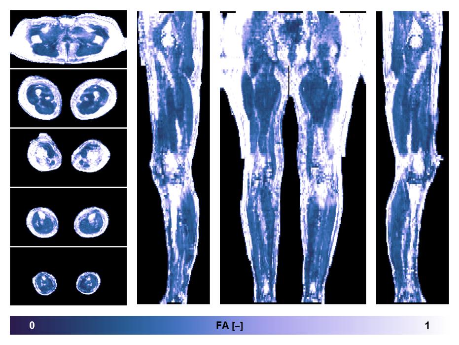 IVIM corrected whole leg muscle fractional anisotropy obtained from diffusion tensor imaging.