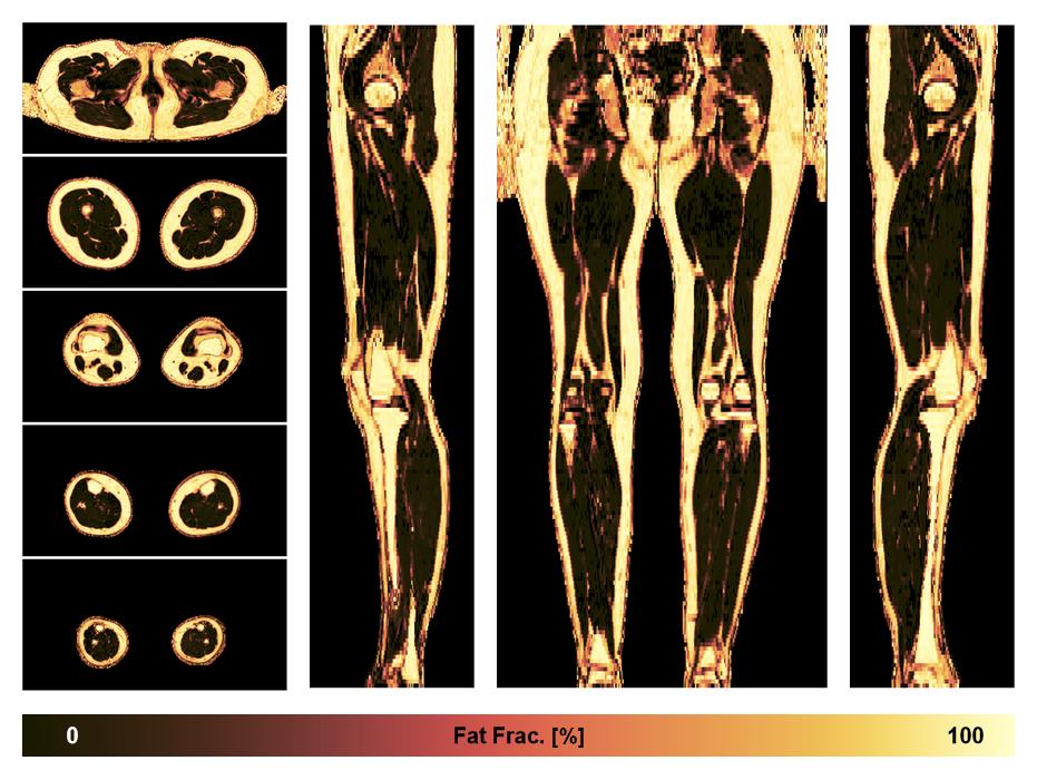 The fat fraction of the lower extremity obtained from the dixon reconstruction for muscle water fat quantification.