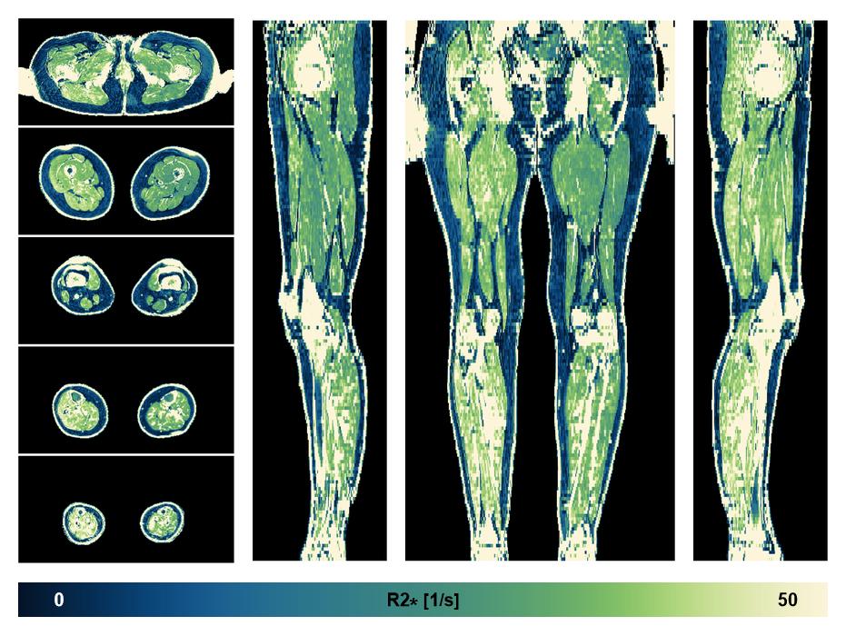 The R2 star relaxation time of the lower extremity obtained from the dixon reconstruction for muscle water fat quantification.
