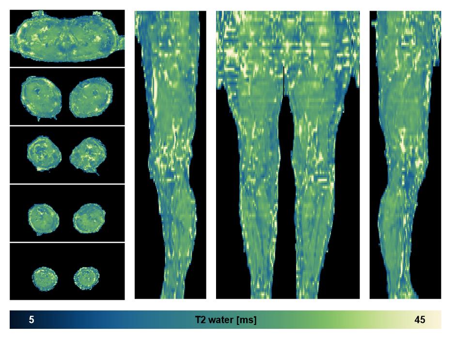 The water only T2 relaxation time of the lower extremity obtained from multi echo spin echo t2 mapping with EPG based reconstruction.
