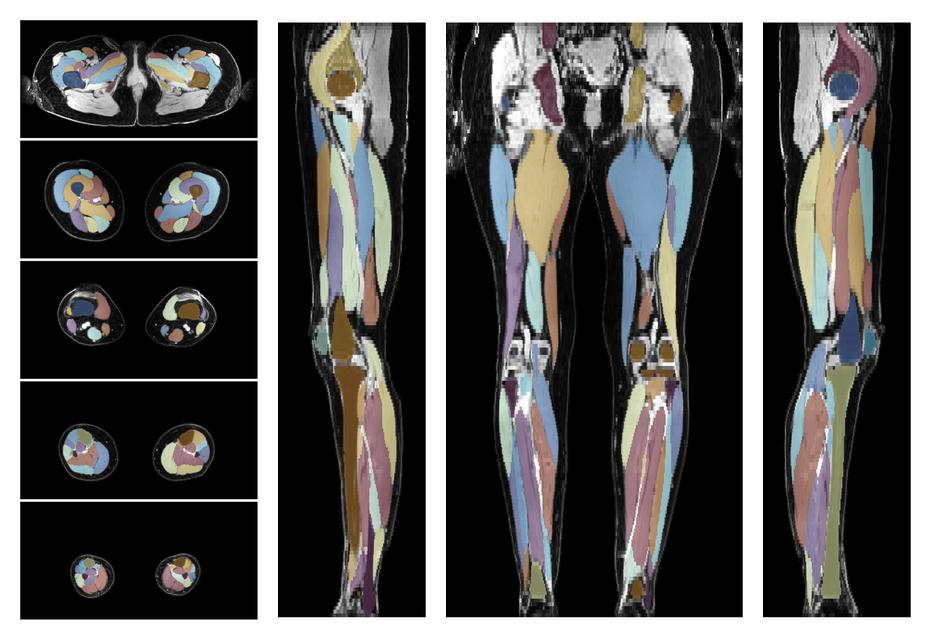 Overlay of automated muscle segmentation labels on dixon water image.