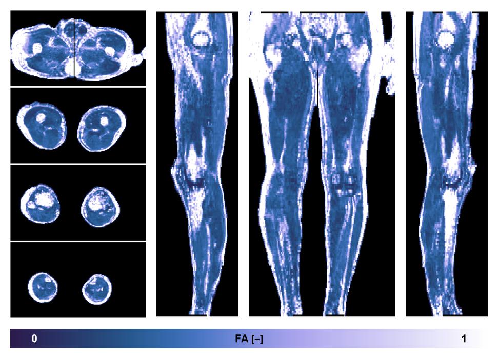 IVIM corrected whole leg muscle fractional anisotropy obtained from diffusion tensor imaging.