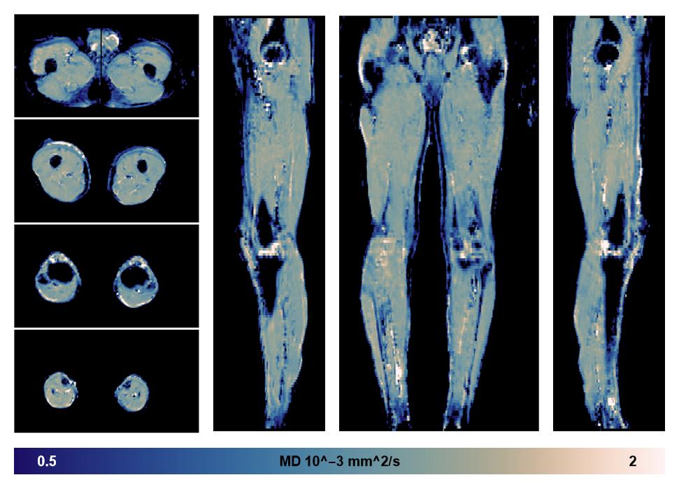 IVIM corrected whole leg muscle mean diffusivity obtained from diffusion tensor imaging.