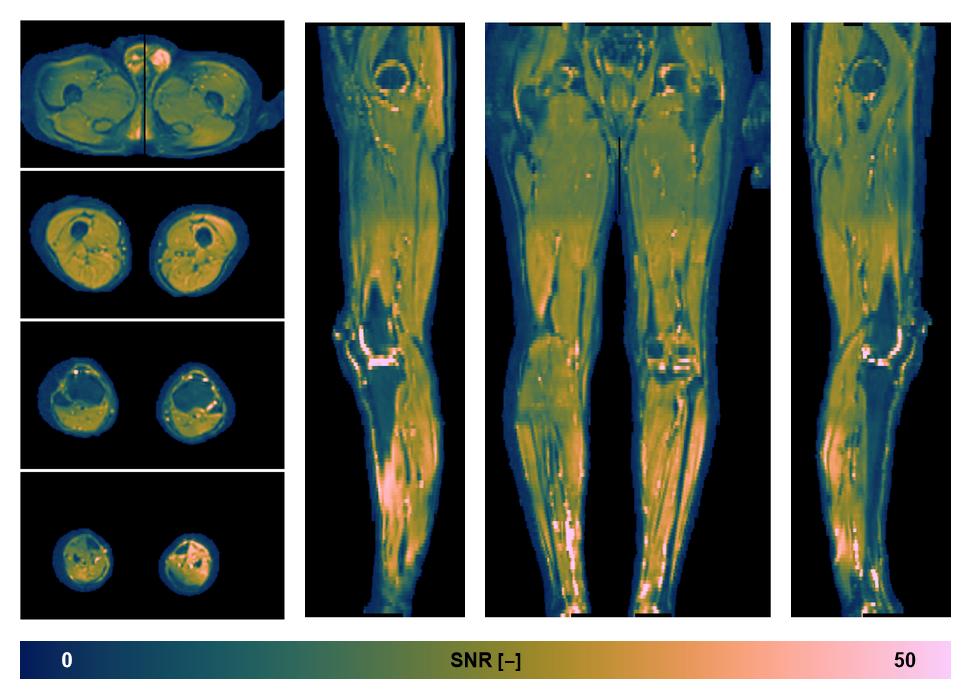 SNR distribution of the unweighted diffusion data.