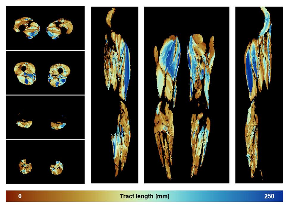 Muscle fiber tract length map based on whole leg DTI based fiber tractography.