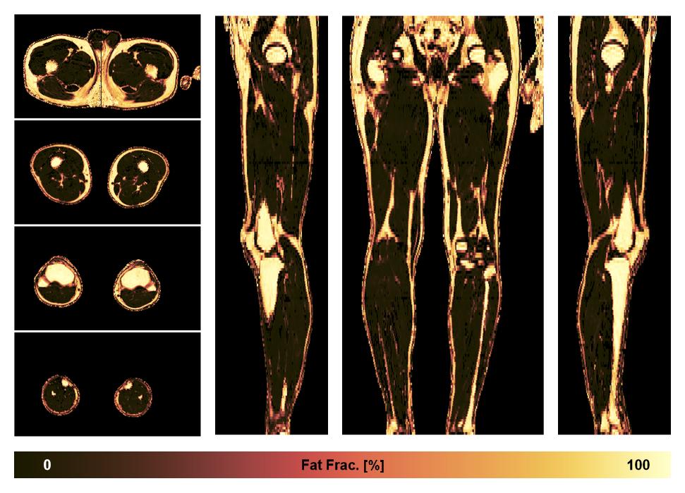 The fat fraction of the lower extremity obtained from the dixon reconstruction for muscle water fat quantification.