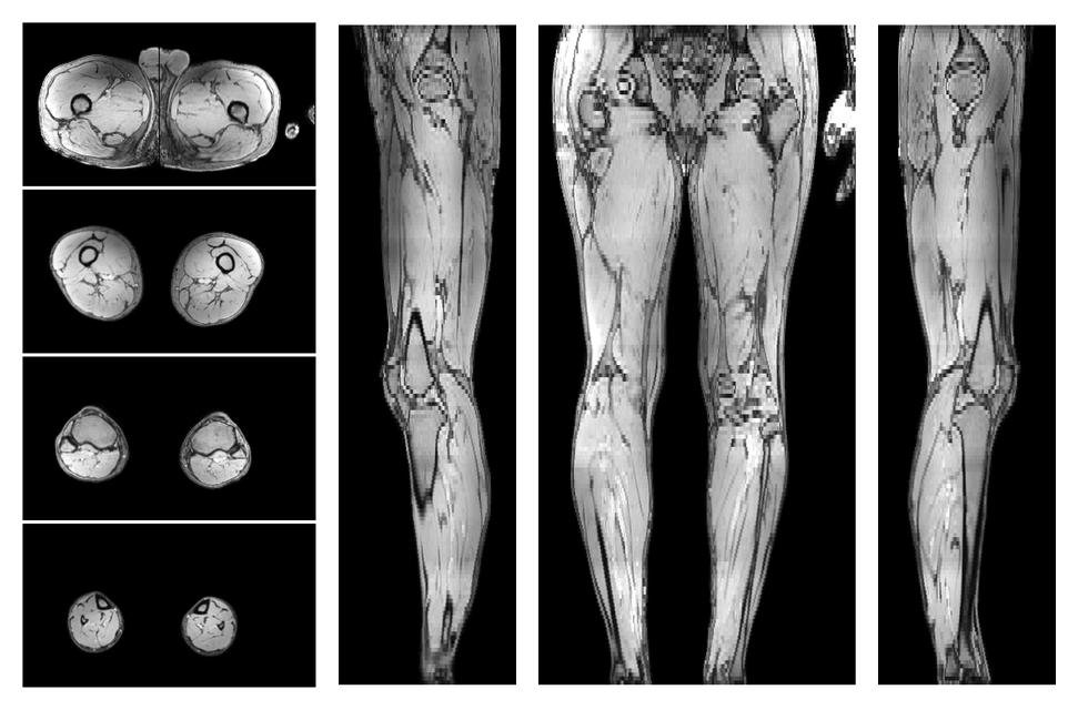 The out-phase image of the dixon reconstruction for water fat quantification.