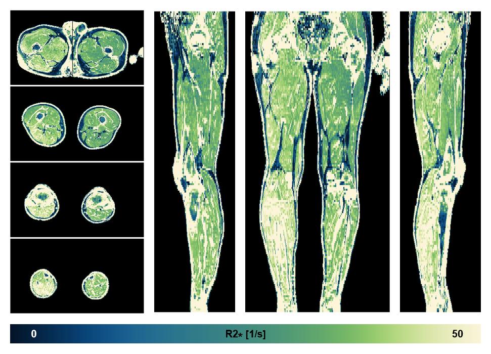 The R2 star relaxation time of the lower extremity obtained from the dixon reconstruction for muscle water fat quantification.