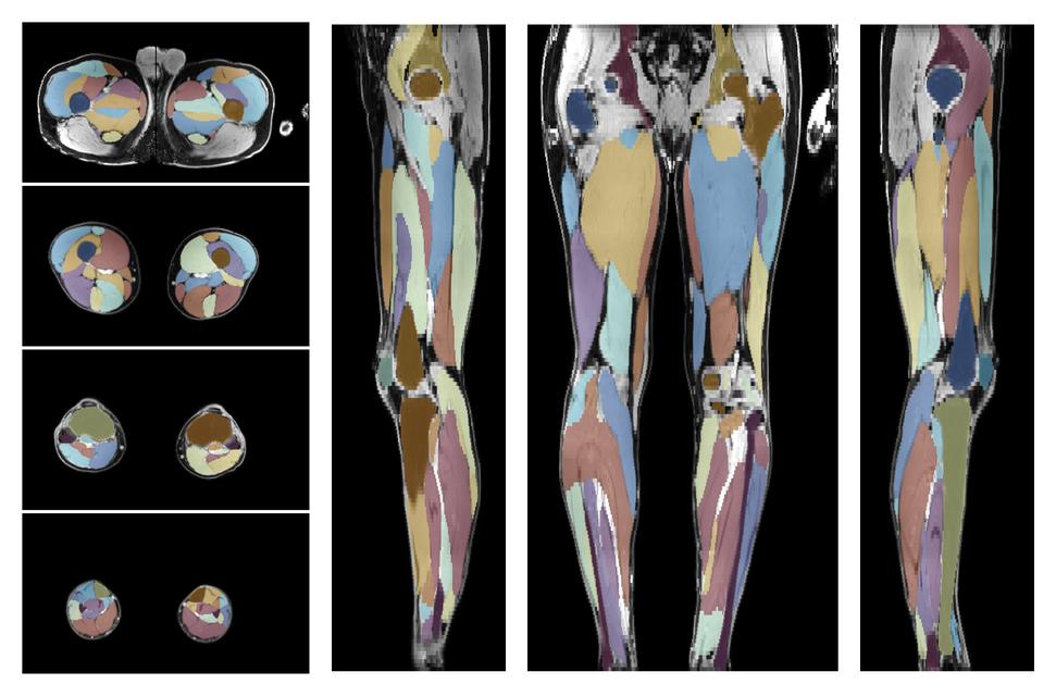 Overlay of automated muscle segmentation labels on dixon water image.