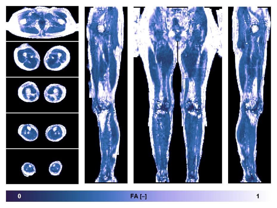 IVIM corrected whole leg muscle fractional anisotropy obtained from diffusion tensor imaging.