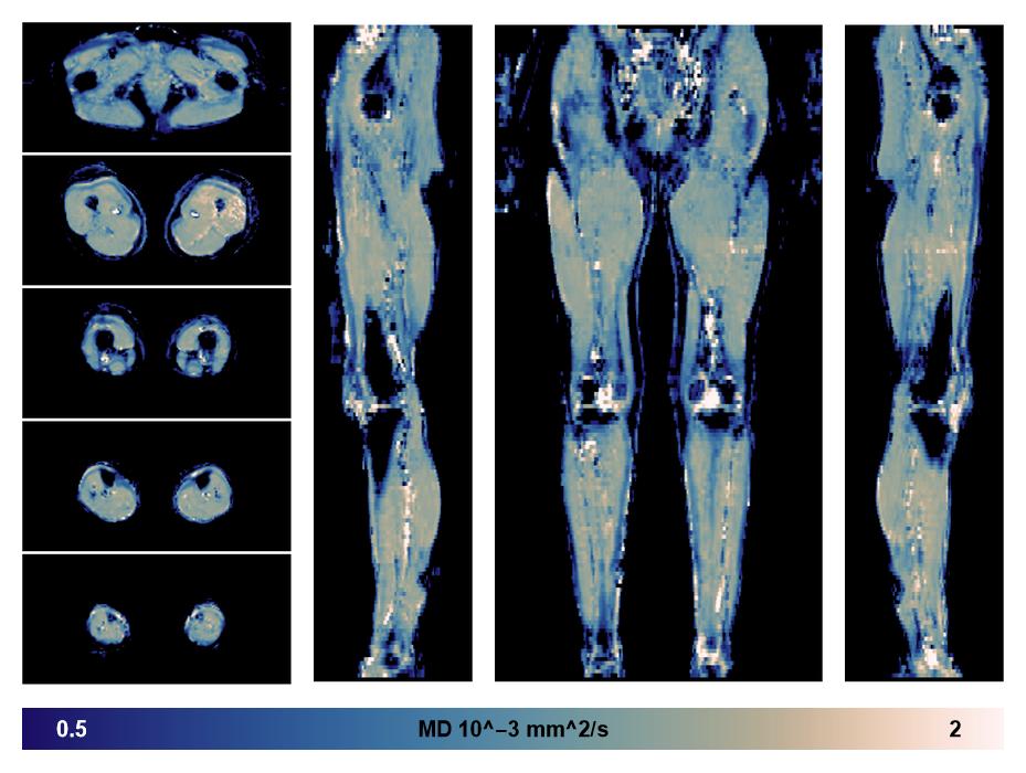 IVIM corrected whole leg muscle mean diffusivity obtained from diffusion tensor imaging.