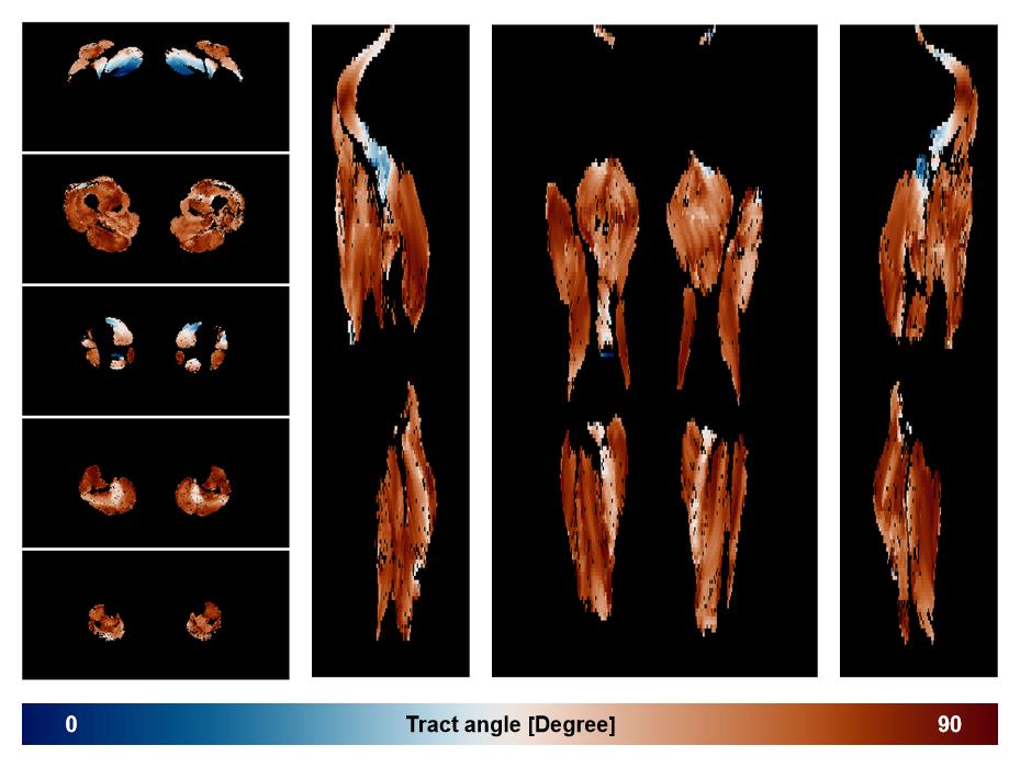 Muscle fiber tract angle map based on whole leg DTI based fiber tractography.