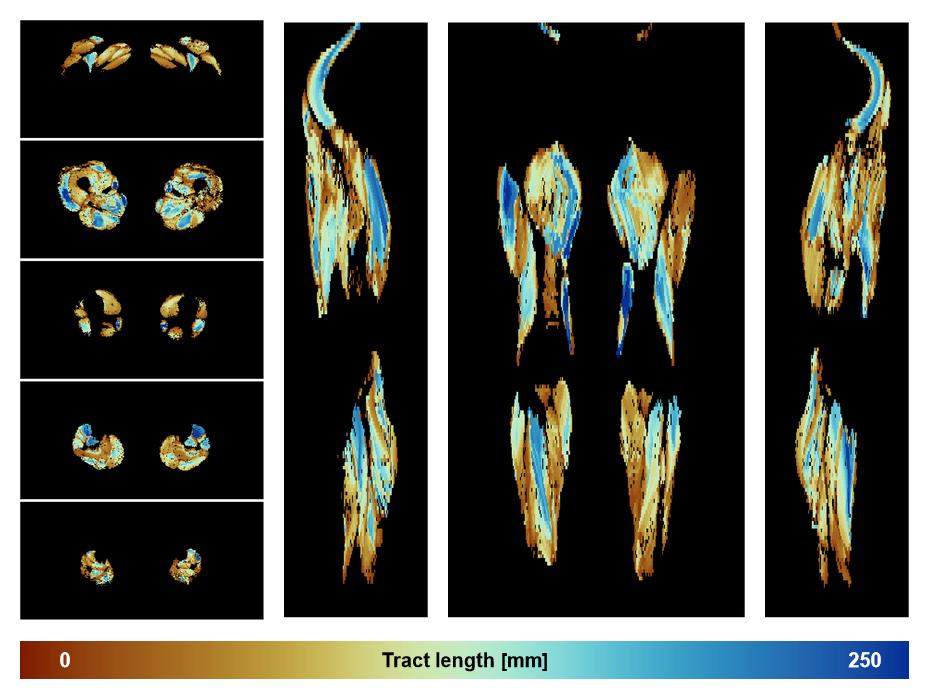 Muscle fiber tract length map based on whole leg DTI based fiber tractography.