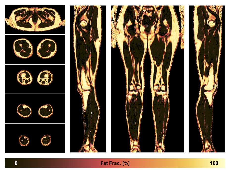 The fat fraction of the lower extremity obtained from the dixon reconstruction for muscle water fat quantification.