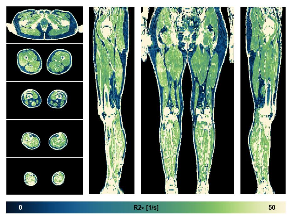 The R2 star relaxation time of the lower extremity obtained from the dixon reconstruction for muscle water fat quantification.