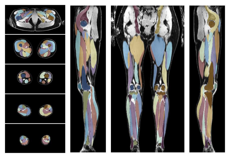 Overlay of automated muscle segmentation labels on dixon water image.