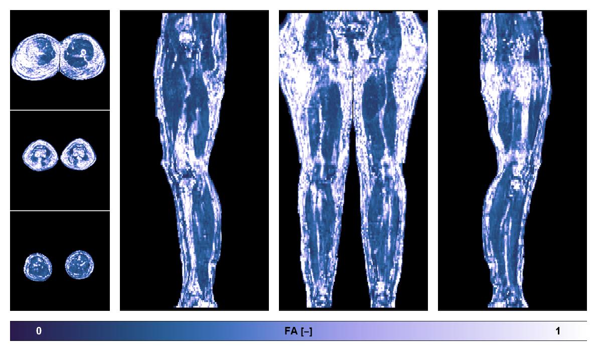 IVIM corrected whole leg muscle fractional anisotropy obtained from diffusion tensor imaging.