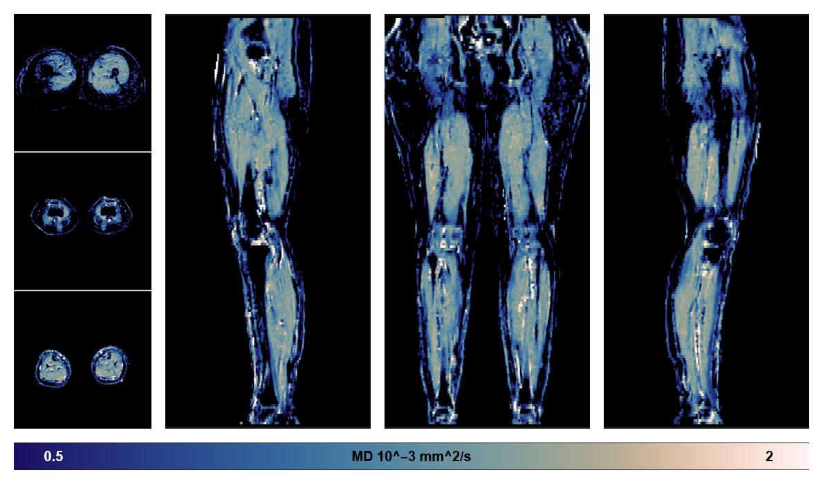 IVIM corrected whole leg muscle mean diffusivity obtained from diffusion tensor imaging.