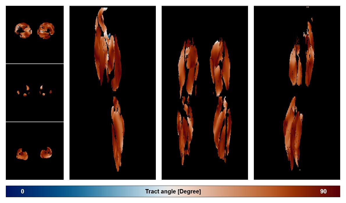 Muscle fiber tract angle map based on whole leg DTI based fiber tractography.