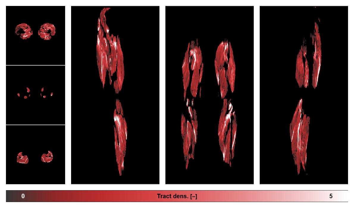 Muscle fiber tract density map based on whole leg DTI based fiber tractography.