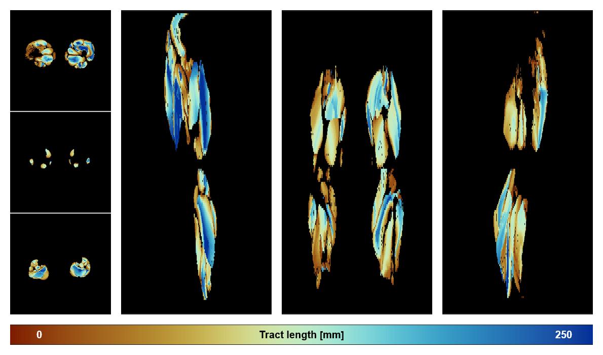 Muscle fiber tract length map based on whole leg DTI based fiber tractography.