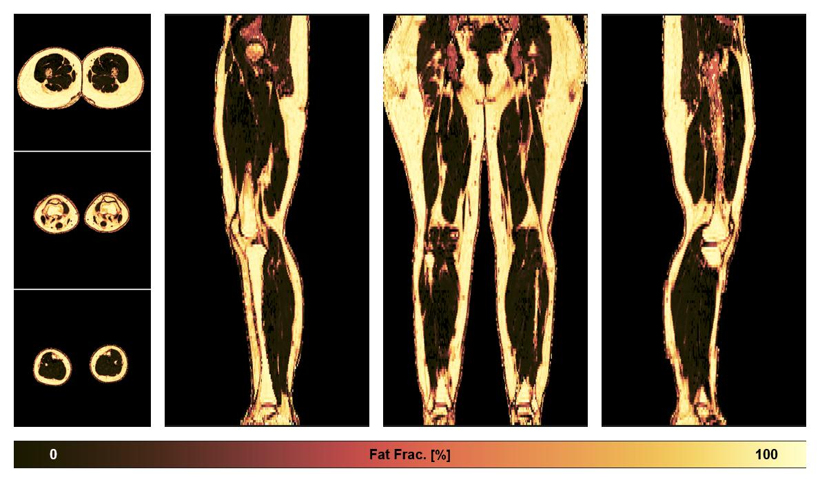 The fat fraction of the lower extremity obtained from the dixon reconstruction for muscle water fat quantification.