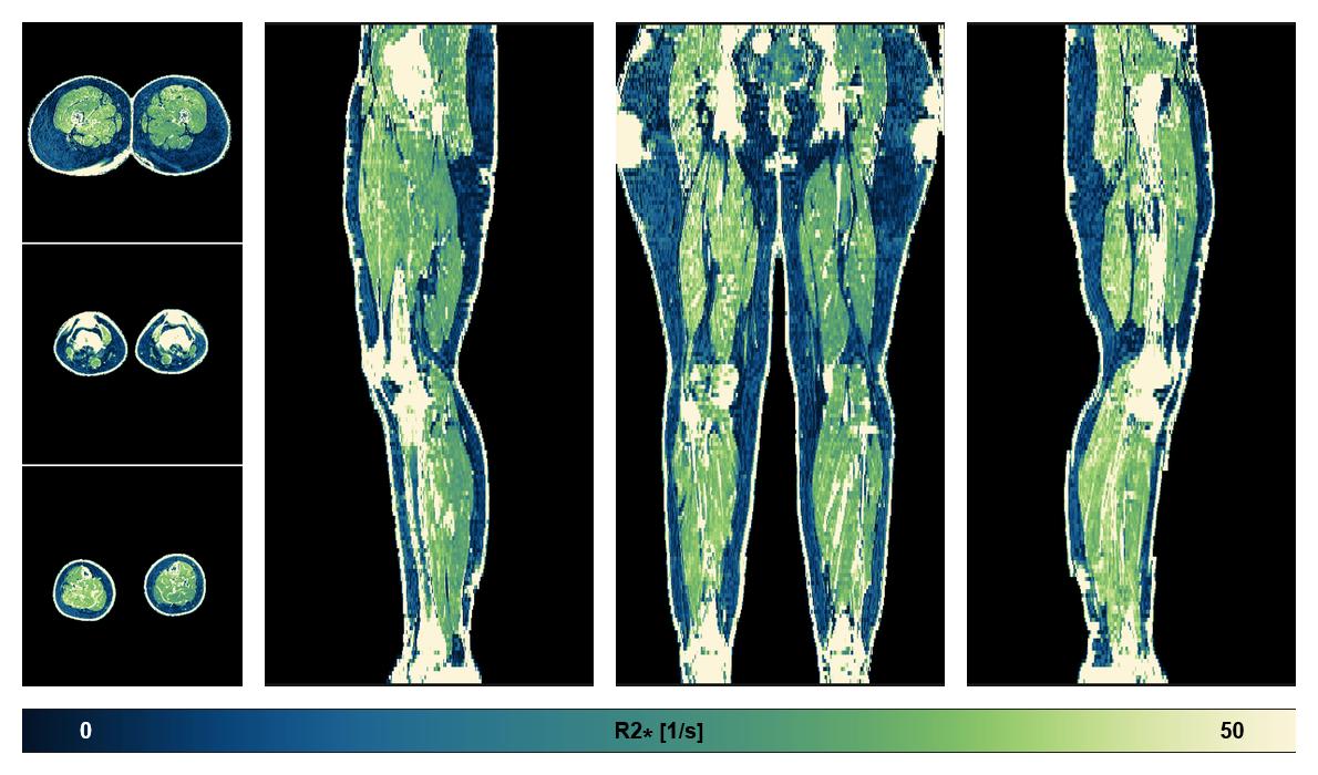 The R2 star relaxation time of the lower extremity obtained from the dixon reconstruction for muscle water fat quantification.