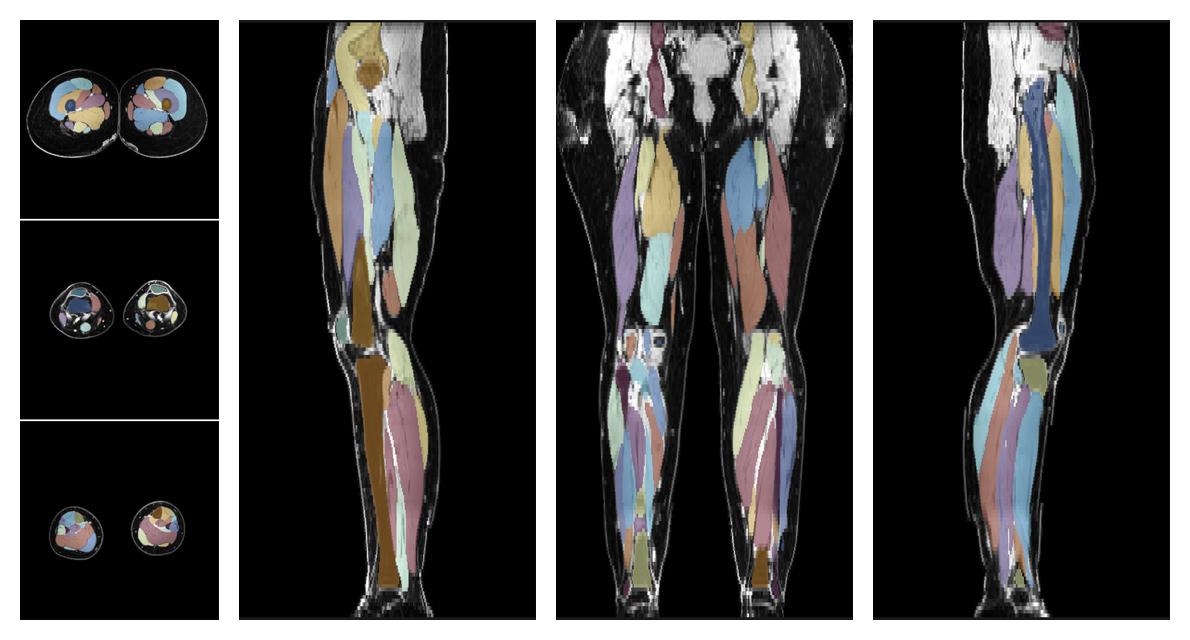 Overlay of automated muscle segmentation labels on dixon water image.