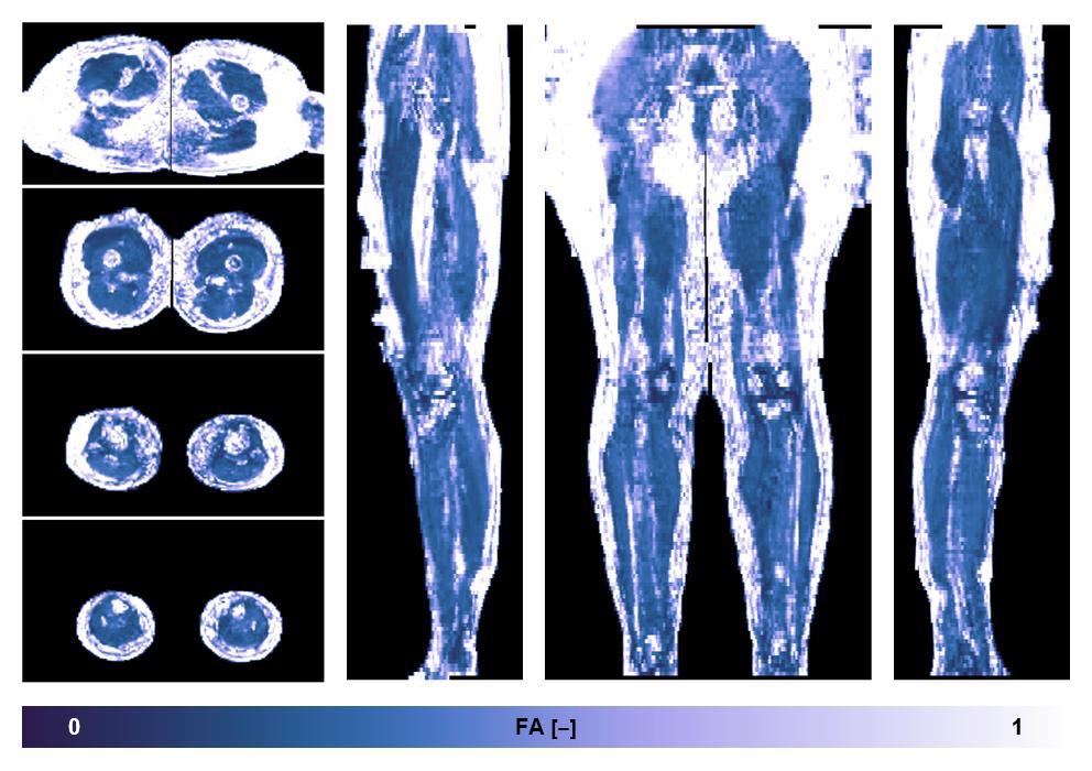 IVIM corrected whole leg muscle fractional anisotropy obtained from diffusion tensor imaging.