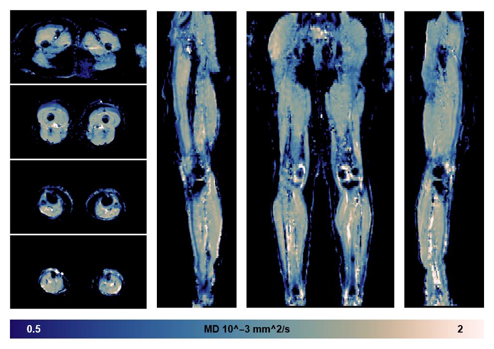 IVIM corrected whole leg muscle mean diffusivity obtained from diffusion tensor imaging.