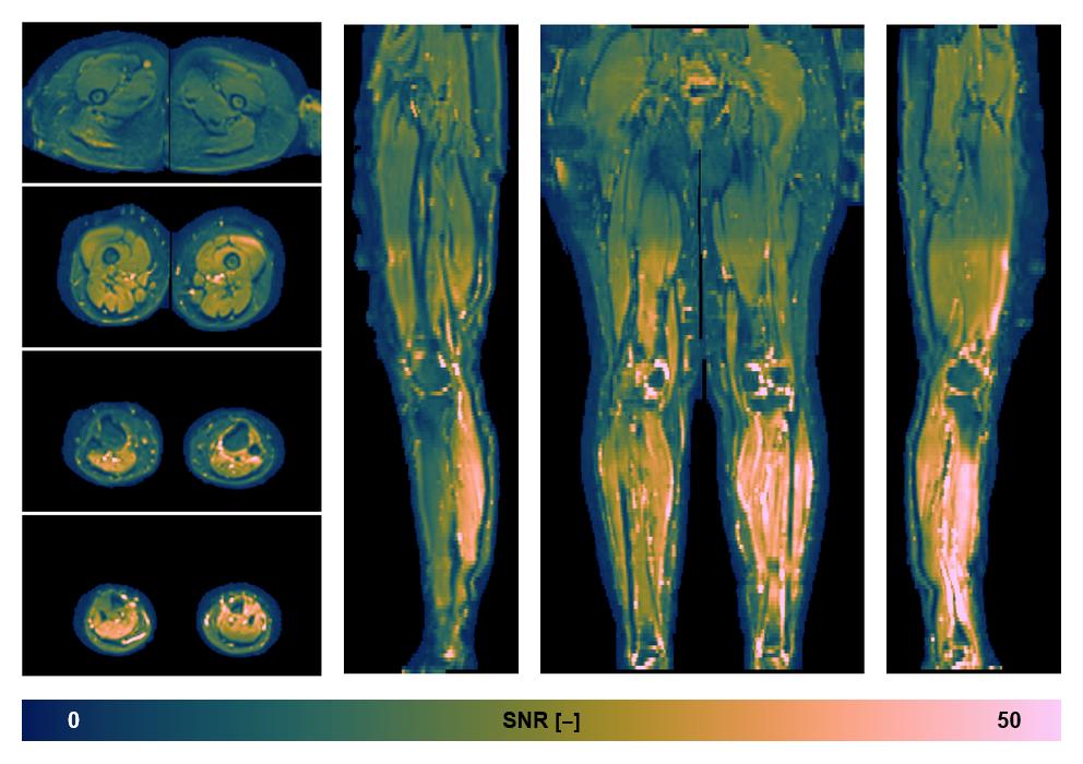 SNR distribution of the unweighted diffusion data.